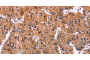 Immunohistochemistry of paraffin-embedded Human liver cancer using ERP29 Polyclonal Antibody at dilution of 1:40 (ERP29 anticorps)
