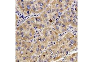 Immunohistochemical analysis of Tropomodulin-4 staining in human liver cancer formalin fixed paraffin embedded tissue section.