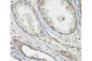 Immunohistochemistry of paraffin-embedded Human prostate cancer using UBE2S Polyclonal Antibody at dilution of 1:100 (40x lens).