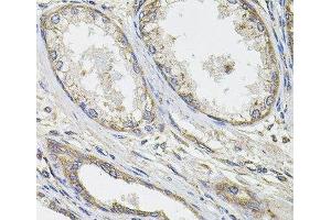 Immunohistochemistry of paraffin-embedded Human prostate cancer using UBE2S Polyclonal Antibody at dilution of 1:100 (40x lens). (UBE2S anticorps)