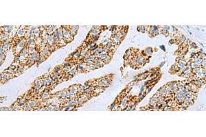 Immunohistochemistry of paraffin-embedded Human gastric cancer tissue using PYCR2 Polyclonal Antibody at dilution of 1:40(x200)