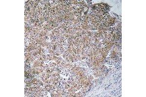 Immunohistochemical analysis of CHST13 staining in human liver cancer formalin fixed paraffin embedded tissue section. (CHST13 anticorps)