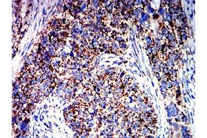Immunohistochemical analysis of paraffin-embedded cervical cancer tissues using ATPIF1 mouse mAb with DAB staining. (ATPase Inhibitory Factor 1 anticorps  (AA 1-106))