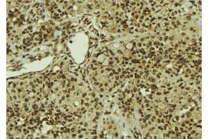 ABIN6279887 at 1/100 staining Human breast cancer tissue by IHC-P. (SART1 anticorps  (C-Term))
