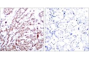 Immunohistochemistry analysis of paraffin-embedded human breast carcinoma, using ATF2 (Phospho-Thr73 or 55) Antibody. (ATF2 anticorps  (pThr73))