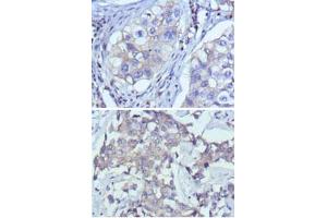 Immunohistochemical analysis of paraffin-embedded human lung cancer (A) and breast cancer (B) using RTN3 monoclonal antibody, clone 10A8  with DAB staining.
