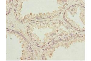 Immunohistochemistry of paraffin-embedded human prostate cancer using ABIN7156132 at dilution of 1:100 (KPNA6 anticorps  (AA 277-536))