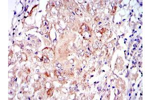 Immunohistochemical analysis of paraffin-embedded lung cancer tissues using PRK2 mouse mAb with DAB staining.
