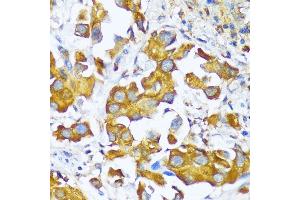 Immunohistochemistry of paraffin-embedded human lung cancer using AARS antibody (ABIN7265526) at dilution of 1:100 (40x lens).