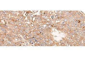 Immunohistochemistry of paraffin-embedded Human liver cancer tissue using SIGLECL1 Polyclonal Antibody at dilution of 1:65(x200) (SIGLECL1 anticorps)