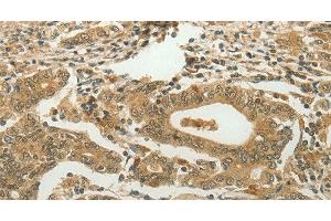 Immunohistochemistry of paraffin-embedded Human gastric cancer using MYSM1 Polyclonal Antibody at dilution of 1:60