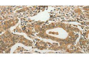 Immunohistochemistry of paraffin-embedded Human gastric cancer using MYSM1 Polyclonal Antibody at dilution of 1:60 (MYSM1 anticorps)