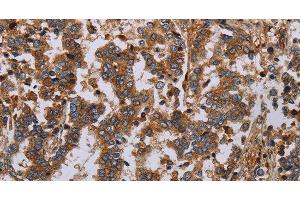 Immunohistochemistry of paraffin-embedded Human liver cancer using GDF2 Polyclonal Antibody at dilution of 1:40 (GDF2 anticorps)