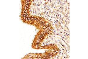 (ABIN6242230 and ABIN6577881) staining Epcam in Human colorectal carcinoma tissue sections by Immunohistochemistry (IHC-P - paraformaldehyde-fixed, paraffin-embedded sections).