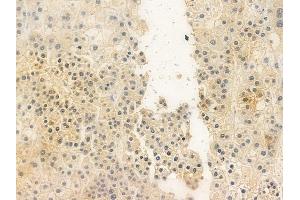 ABIN6257911 and ABIN6274384 at 1/100 staining human hepatocellular carcinoma by IHC-P.