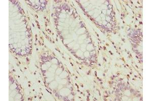 Immunohistochemistry of paraffin-embedded human colon cancer using ABIN7174542 at dilution of 1:100 (UBL3 anticorps  (AA 17-114))
