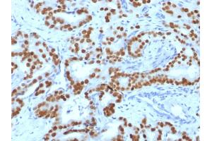 Formalin-fixed, paraffin-embedded human Prostate Carcinoma stained with FOXA1 Monoclonal Antibody (FOXA1/1519). (FOXA1 anticorps  (AA 372-472))