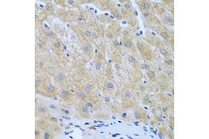 Immunohistochemistry of paraffin-embedded human liver cancer using Furin antibody (ABIN6127933, ABIN6140815, ABIN6140817 and ABIN6223322) at dilution of 1:100 (40x lens). (FURIN anticorps  (AA 120-370))