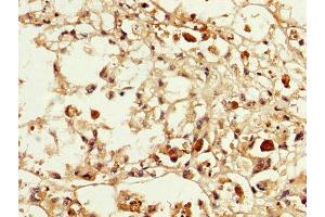 IHC image of ABIN7159260 diluted at 1:200 and staining in paraffin-embedded human melanoma performed on a Leica BondTM system.