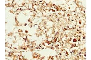 IHC image of ABIN7159260 diluted at 1:200 and staining in paraffin-embedded human melanoma performed on a Leica BondTM system. (MAGEA3 anticorps  (AA 2-104))
