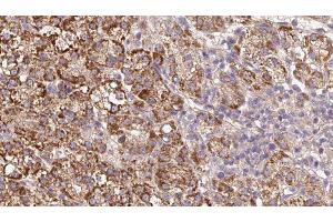 ABIN6279591 at 1/100 staining Human liver cancer tissue by IHC-P. (UNC5A anticorps  (Internal Region))