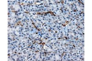 Immunohistochemical staining of paraffin-embedded Adenocarcinoma of ovary tissue using anti-CD36 mouse monoclonal antibody. (CD36 anticorps)