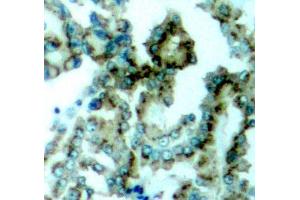 Immunohistochemistry of paraffin-embedded human lung carcinoma tissue, using Phospho-PKCalpha/beta II-T638/641 antibody (ABIN2987563). (PKC beta anticorps  (pThr641))