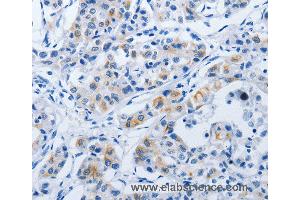 Immunohistochemistry of Human lung cancer using BPIFB3 Polyclonal Antibody at dilution of 1:50 (BPIFB3 anticorps)