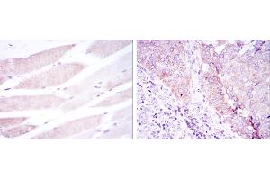 Immunohistochemical analysis of paraffin-embedded muscle tissues (left) and kidney cancer tissues (right) using BMPR2 mouse mAb with DAB staining. (BMPR2 anticorps)
