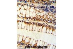 Formalin-fixed and paraffin-embedded human colon carcinoma reacted with BCL2L11 Antibody (Center), which was peroxidase-conjugated to the secondary antibody, followed by DAB staining.