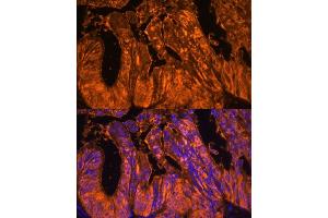 Immunofluorescence analysis of human colon carcinoma using Galectin 4/LG Polyclonal Antibody (ABIN7267339) at dilution of 1:100 (40x lens).