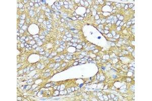 Immunohistochemistry of paraffin-embedded Human colon carcinoma using MLKL Polyclonal Antibody at dilution of 1:200 (40x lens). (MLKL anticorps)