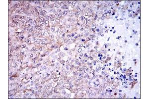 Immunohistochemical analysis of paraffin-embedded ovarian cancer tissues using NQO1 mouse mAb with DAB staining.