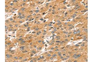 The image on the left is immunohistochemistry of paraffin-embedded Human liver cancer tissue using ABIN7192624(SPATA18 Antibody) at dilution 1/20, on the right is treated with synthetic peptide. (SPATA18 anticorps)