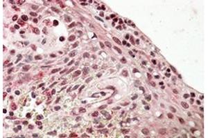 Immunohistochemistry (Paraffin-embedded Sections) (IHC (p)) image for anti-PR Domain Containing 1, with ZNF Domain (PRDM1) (Internal Region) antibody (ABIN615923) (PRDM1 anticorps  (Internal Region))
