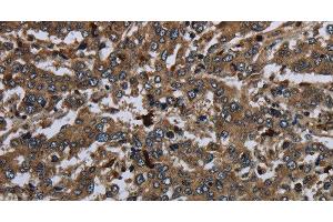 Immunohistochemistry of paraffin-embedded Human liver cancer using CD42b Polyclonal Antibody at dilution of 1:60 (CD42b anticorps)