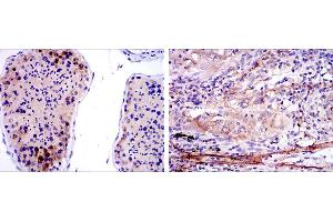 Immunohistochemical analysis of paraffin-embedded testis tissues (left) and lung cancer tissues (right) using SMN1 mouse mAb with DAB staining.