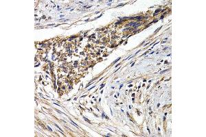 Immunohistochemistry of paraffin-embedded human esophagus cancer using FZR1 antibody at dilution of 1:200 (40x lens). (FZR1 anticorps)