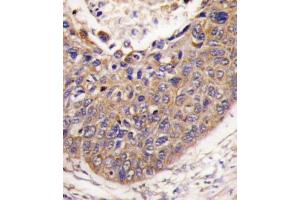 Formalin-fixed and paraffin-embedded human lung carcinoma tissue reacted with FXN antibody (C-term) (ABIN390377 and ABIN2840779) , which was peroxidase-conjugated to the secondary antibody, followed by DAB staining. (Frataxin anticorps  (C-Term))