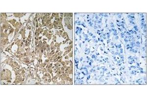 Immunohistochemistry analysis of paraffin-embedded human breast carcinoma tissue, using BUB1 Antibody. (BUB1 anticorps  (AA 251-300))