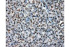 Immunohistochemical staining of paraffin-embedded Adenocarcinoma of colon tissue using anti-APP mouse monoclonal antibody. (APP anticorps)