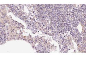 ABIN6273159 at 1/100 staining Human lymph cancer tissue by IHC-P. (SEC24A anticorps  (Internal Region))