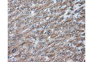 Immunohistochemical staining of paraffin-embedded Carcinoma of liver tissue using anti-NIT2 mouse monoclonal antibody.