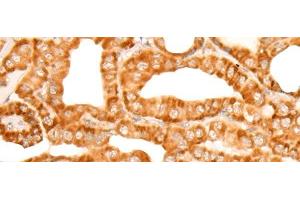 Immunohistochemistry of paraffin-embedded Human thyroid cancer tissue using ZMYND10 Polyclonal Antibody at dilution of 1:35(x200)