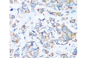 Immunohistochemistry of paraffin-embedded Human breast cancer using ARHGEF5 Polyclonal Antibody at dilution of 1:100 (40x lens). (ARHGEF5 anticorps)