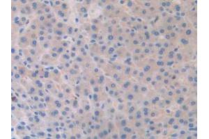 IHC-P analysis of Human Liver Cancer Tissue, with DAB staining. (SLIT1 anticorps  (AA 647-835))
