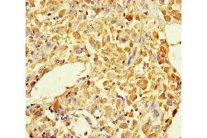Immunohistochemistry of paraffin-embedded human melanoma using ABIN7145605 at dilution of 1:100 (MUTED anticorps  (AA 2-187))