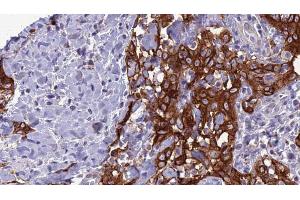 ABIN6266638 at 1/100 staining Human Head and neck cancer tissue by IHC-P. (Synaptophysin anticorps  (Internal Region))