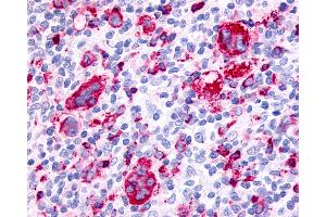 Anti-F2RL3 / PAR4 antibody IHC of human Lymph Node, Hodgkins Lymphoma.