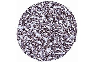 Hepatocellular carcinoma with strong Hepatocyte immunostaining of all tumor cells (Hepatocyte Specific Antigen anticorps)